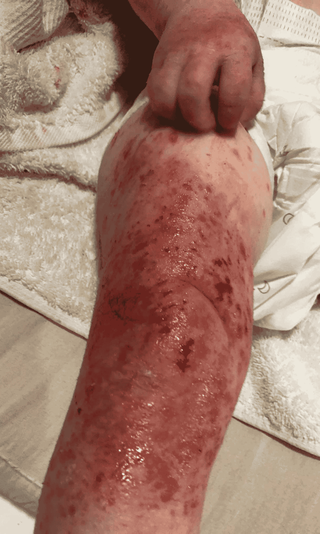 Close-up of a toddler’s leg and hand showing severe topical steroid withdrawal symptoms including inflamed, weeping, oozing, red, and broken skin.
