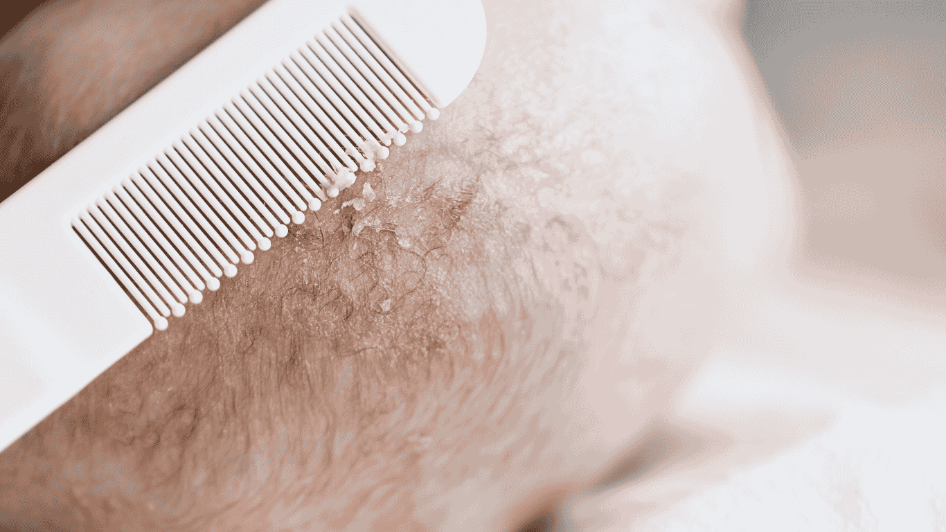 Close-up of a baby's scalp with cradle cap, showing dry, flaky skin being gently combed with a fine-toothed white comb.
